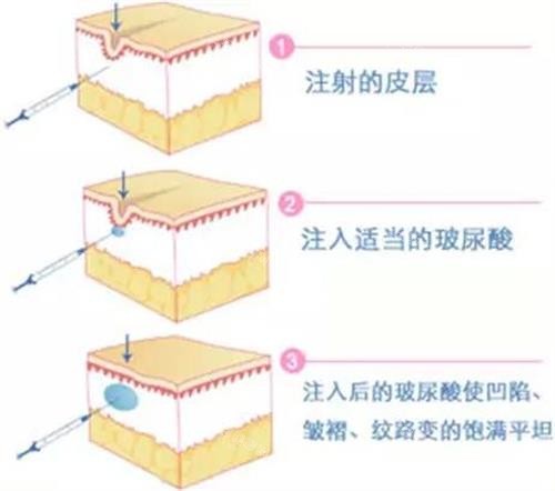 欧提拉玻尿酸是什么档次？中高端档次！为您解析多个内部资料