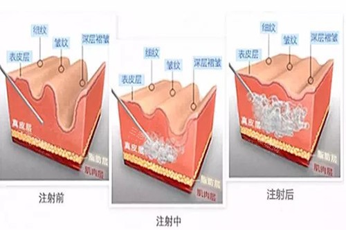 薇琳卓悦1号玻尿酸好用吗？好用！从多个方面深入解析这款产品