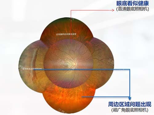 白内障多焦点人工晶体选择禁忌症有哪些？各种禁忌症文内有详细列举！