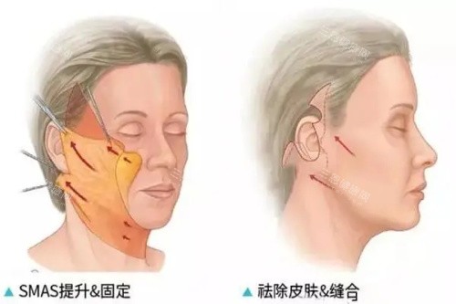 和魏广运同级别的拉皮医生还有谁？李晓东、冯立哲与魏广运技术、价格差异解析