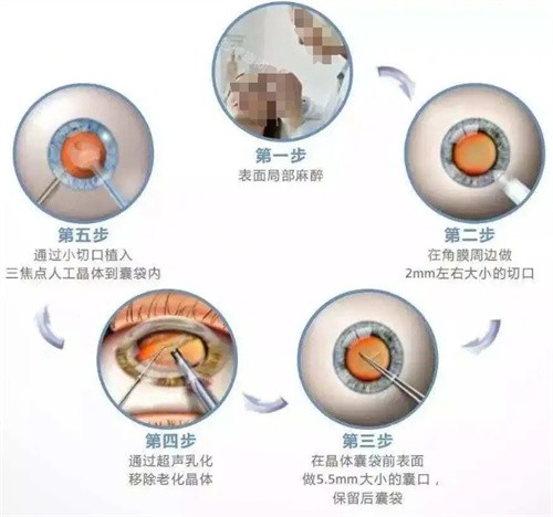 武汉白内障手术免费政策！2025年活动！哪些医院可做？申请条件全解析！