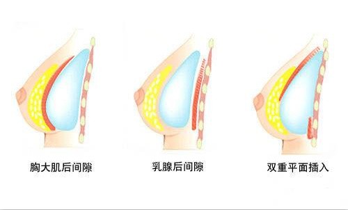 隆胸假体植入方式示意图