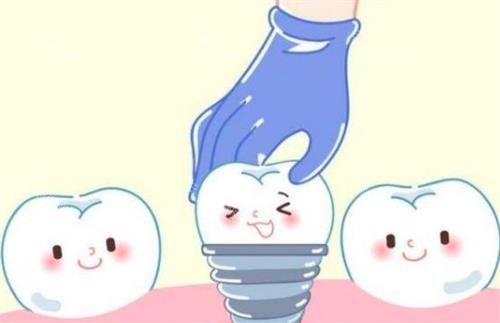 种植体动画图 种植体动画图