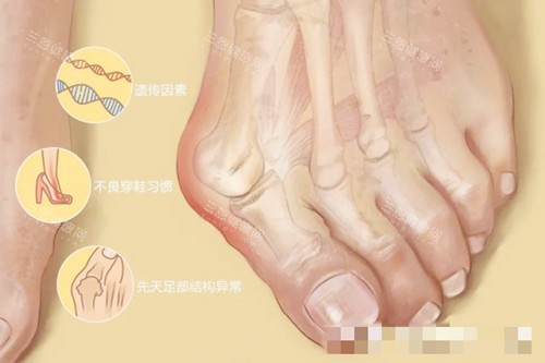 苏敬达和温建民谁做大脚骨更牛？医生技术各有特色！对比解析苏敬达和温建民做大脚骨技术、价格、口碑等