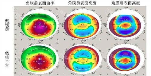 角膜检查