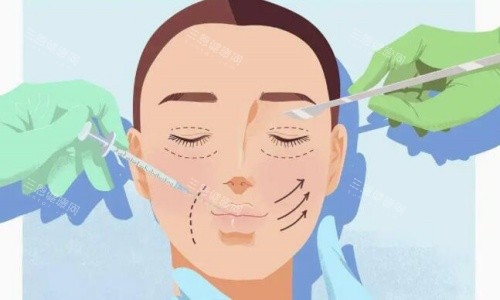 双眼皮手术操作示意图