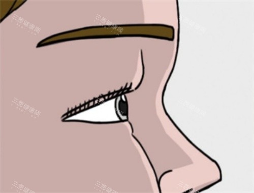 肿眼泡单眼皮示意图