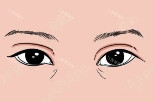 双眼皮失败卡通图