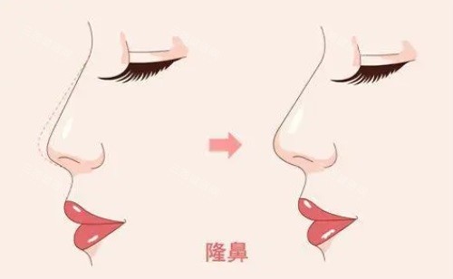 张家口做隆鼻哪家好？维多利亚/天宏隆鼻稳到没话说