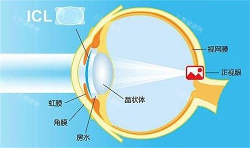 北京同仁医院ICL晶体植入3.2万起！2025年费用含检查+晶体明细!