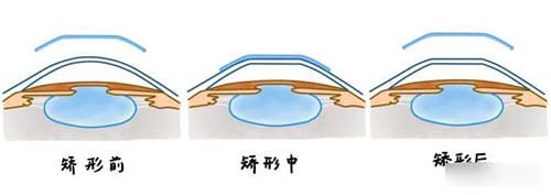 晶体植入矫正近视前中后漫画示意图