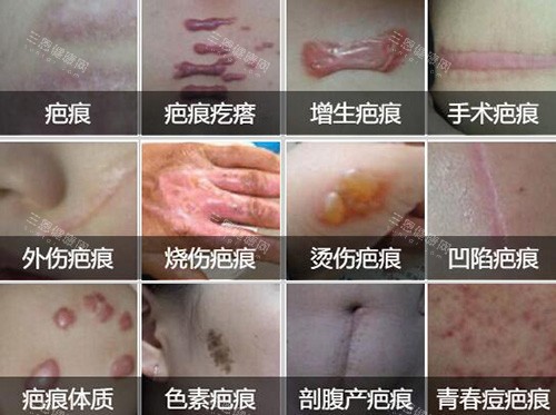 常见的疤痕类型展示图