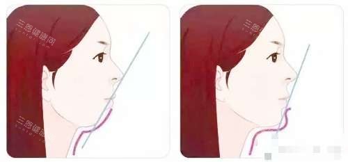 深覆合矫正前后脸型对比图
