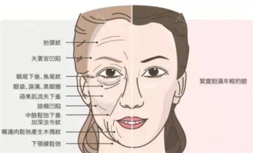 伊妍仕少女针容易栓塞吗？从成分、技术原理、操作规范以等解析