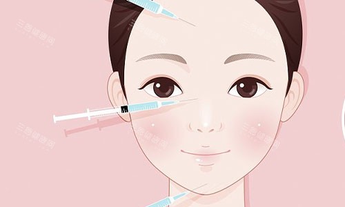 注射美容的部位示意图