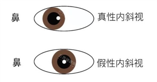 斜视的类型