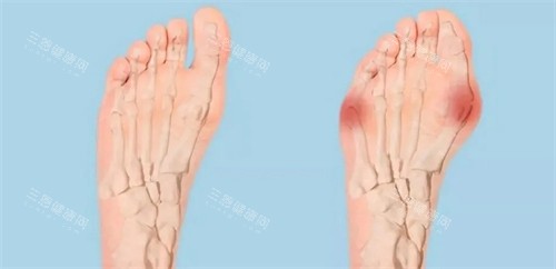 正常脚和大脚骨