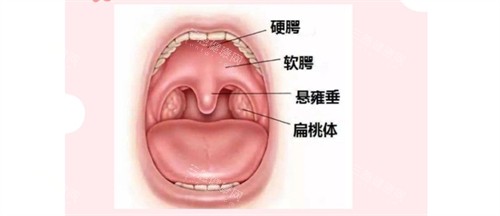 唇腭裂示意图