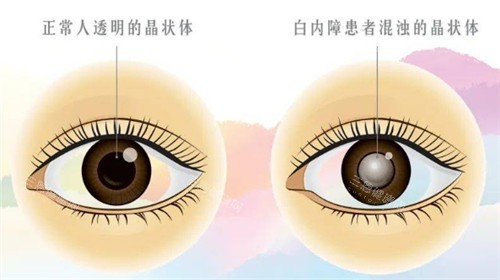 2025黄石白内障手术免费政策解读，适用人群/免费项目/申请条件与流程查看！