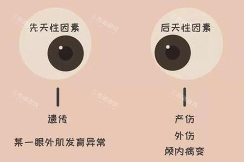 斜视眼睛照片图