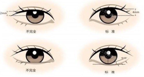 双眼皮示意图