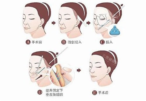 筋膜提升术5年后真实状态曝光！无痕提拉到底是逆龄神器还是毁容陷阱？医生这样说！