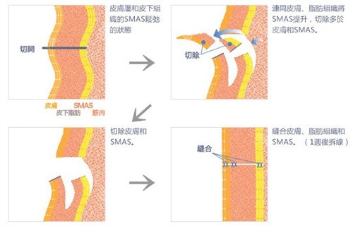 整形医生深度科普：筋膜提升术到底能维持几年？术后脸垮是真的吗？看完这篇就懂了！