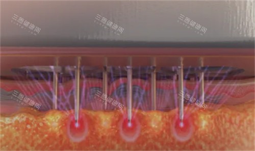 黑曜双波微针单次价格多少钱?6000~9000元起,SYLFIRM X收费标准与疗程方案建议