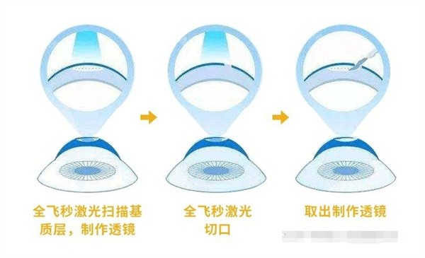 郑州全飞秒手术医院哪家强？郑州做全飞这5家眼科医院很推荐很推荐！