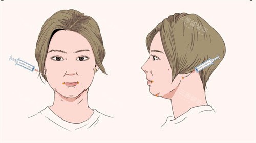 南方医科大学皮肤病医院面部吸脂手术针管注射点位动画图