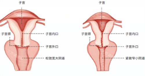 武汉极美伽阴道紧缩术施术位置图解