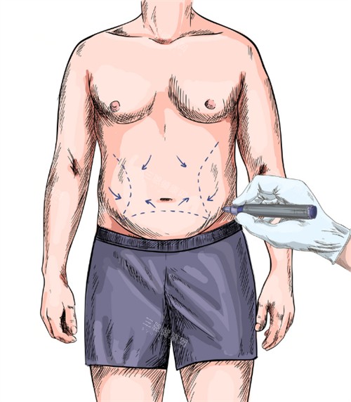 男生肚脐整形