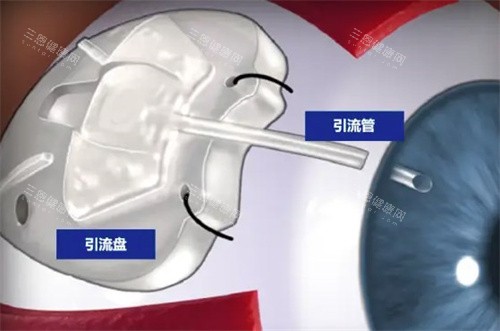 青光眼引流阀