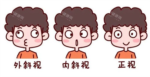 斜视的种类