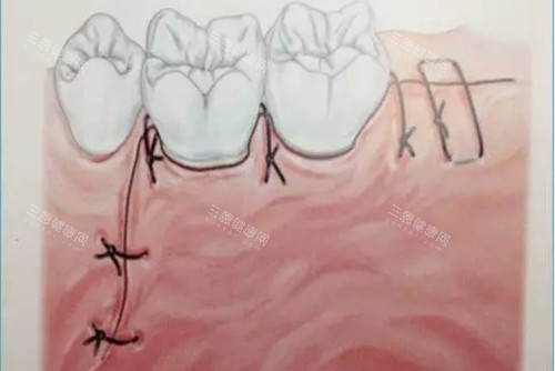 牙龈翻瓣切口卡通示意图