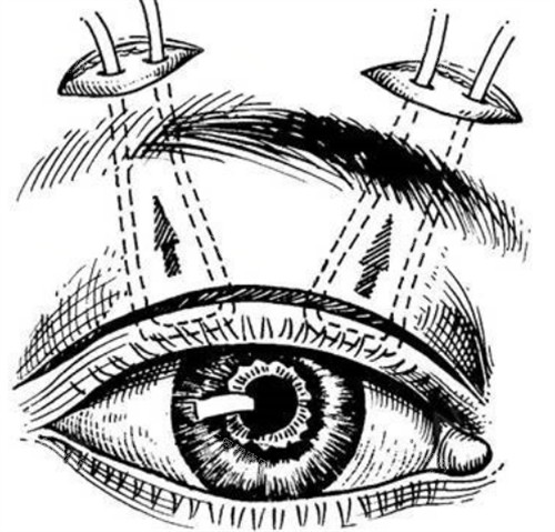 做眼修复找郑州杨丽跟孔宇谁好？按情况选择，杨丽处理疤痕粘连一绝|孔宇上睑下垂修复牛