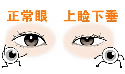 正常眼和下垂眼对比