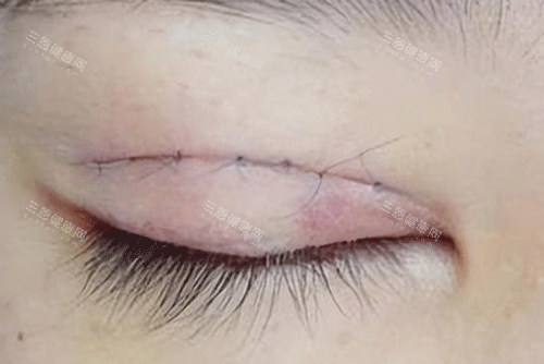 双眼皮疤痕明显照片