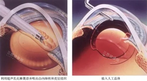 芜湖2025年白内障手术免费政策全新消息来了！快来看看你是否符合条件还能省下大笔钱！