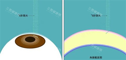 爱尔眼科做近视眼手术费用更新，2025年做准分子8000+半飞秒9800+全飞秒15800+点击了解！
