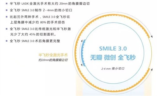 全飞秒手术3.0