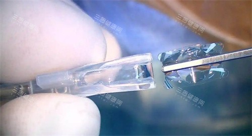 龙晶是哪个公司的产品?是爱博诺德国产创新力作,龙晶®PR型有晶体眼人工晶状体技术解析