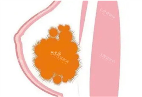 胸部奥美定