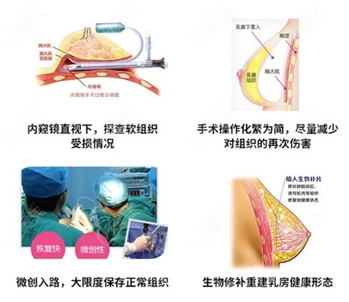 脸上注射奥美定不取会有什么后果？真实术例分享和取出手术全指南！