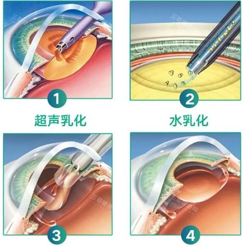 江苏省2025年白内障手术免费政策全新汇总！哪些人群可以享受？如何申请？