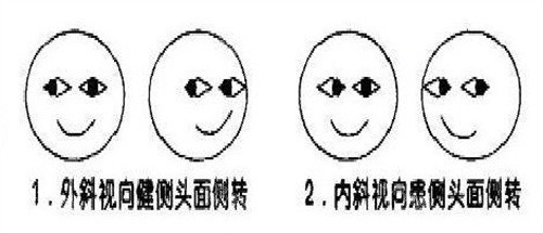 斜视自测图