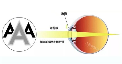 常州华厦谱瑞眼科老花眼的眼睛