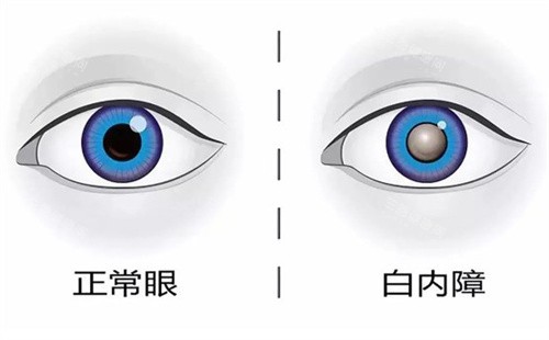 2025河北省眼科医院价格表，查询白内障/近视矫正/青光眼/眼底病/青光眼/角膜病等费用