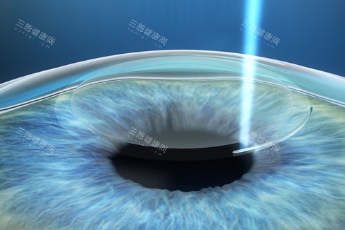 近视手术选普瑞眼科靠谱吗？医生资历、设备、价格多方位测评！