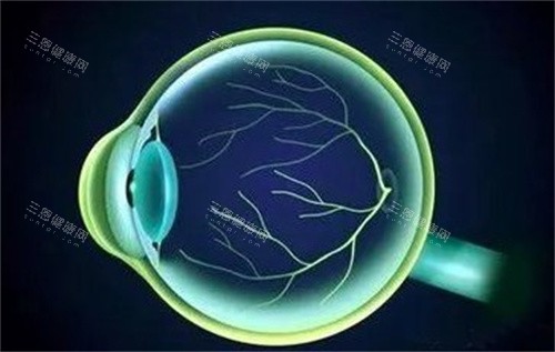 飞蚊症眼球